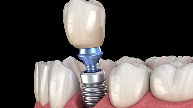 Dental implants - Double the tool life